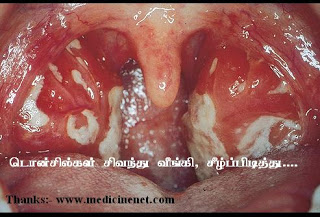 நெறிக்கட்டியுடன் காய்ச்சல் Infectious-mononucleosis