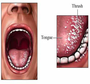 الأعشاب و النباتات كنز لا يفنى Oralthrush