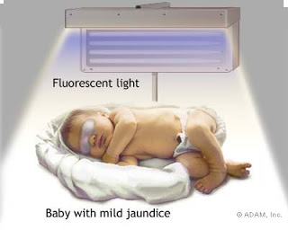 மஞ்சள் காமாலை :மஞ்சள் நிறமே மஞ்சள் நிறமே! PHOTOTHERAPY