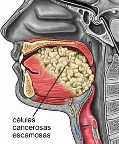 El sexo oral causa el 27% de los cáncer de boca. Cancer_oral_bucal_lengua_piso