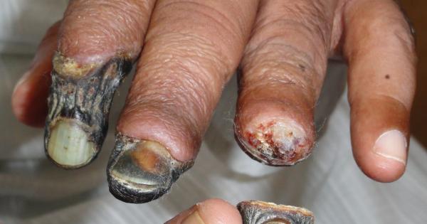 Krokodil, la droga que "devora" al Adicto, Ya está en México Krokodil