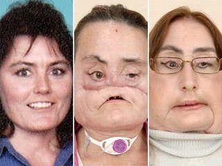 EEUU realiza el mayor trasplante de cara del mundo Ht_face_transplant_090505_mn