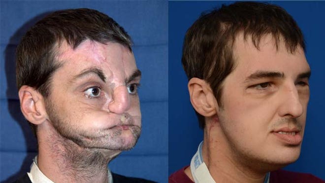 Face Transplant Patient Thrives With New Look Full%20Face%20Transplant%20Before%20After