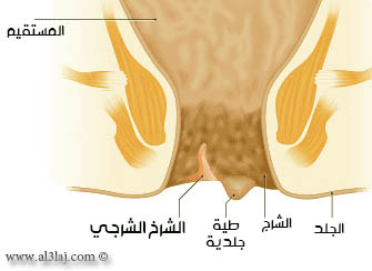 الشرخ الشرجي AnalFissure