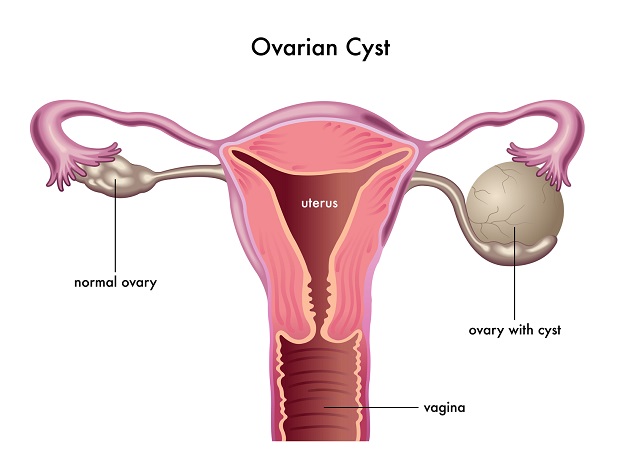 الجهاز التناسلي للذكر والأنثى  Ovarian-cyst