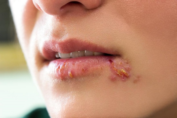 الحلأ البسيط ( الحمو الباطني ) .. مرض جلدي فيروسي متكرر Herpes.3