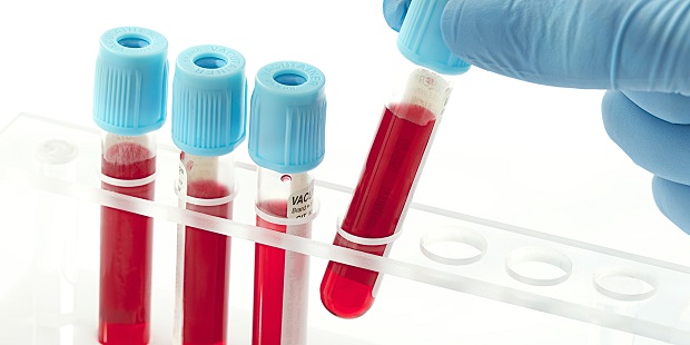 أحكام وأهمية وفوائد الفحص الطبي قبل الزواج  BLOOD-TEST