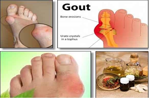 أسباب مرض النقرس وعلاجه ودور الغذاء في الإصابة والوقاية The-Gout