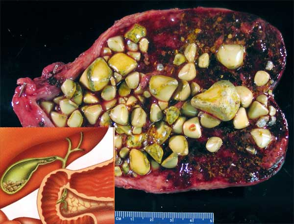 اسباب ظهور حصاة المرارة...وطريقة علاجها GallBladderStones