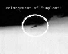 "Alien Implants" IF YOU FIND THIS STRANGE MARK... Implant-oo3