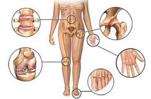 À quoi peuvent-être dues les douleurs dans les bras et les jambes? Douleurs-articulaires