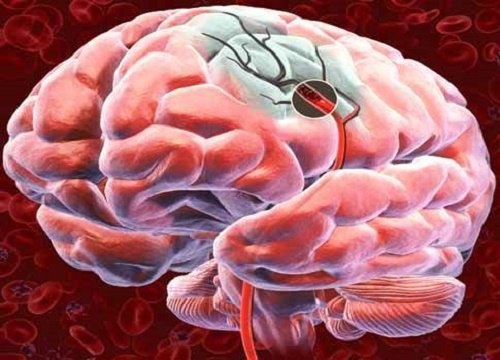 Quels sont les signaux d’alerte d’une hémorragie cérébrale et comment la prévenir ? Cerveau-vasculaire-sante-500x360-500x360
