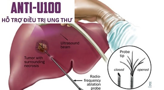 Phát hiện mới trong điều trị ung thư gan giai đoạn cuối Phat-hien-moi-trong-dieu-tri-ung-thu-gan-giai-doan-cuoi(1)