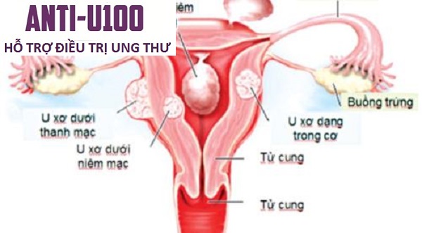 Sức khỏe, đời sống: Triệu chứng báo động ung thư chị em nên chú ý U%20xo%20t%E1%BB%AD%20cung%281%29