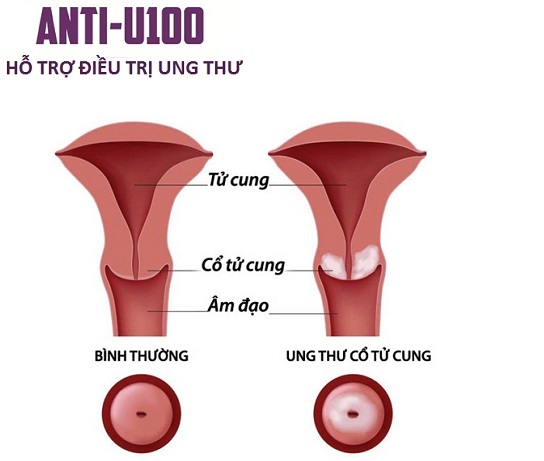 Điều trị bệnh ung thư cổ tử cung theo Đông Y Ung-thu-co-tu-cung(3)