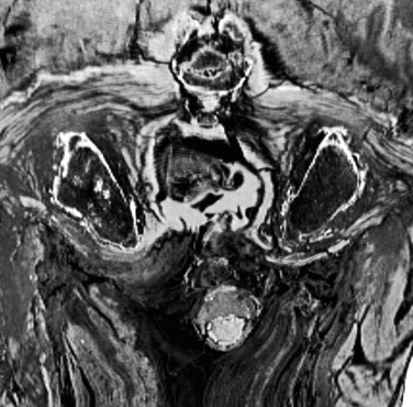 Prostate metastatic bone cancer in an Egyptian Ptolemaic mum 1-s2.0-S1879981711000271-gr2