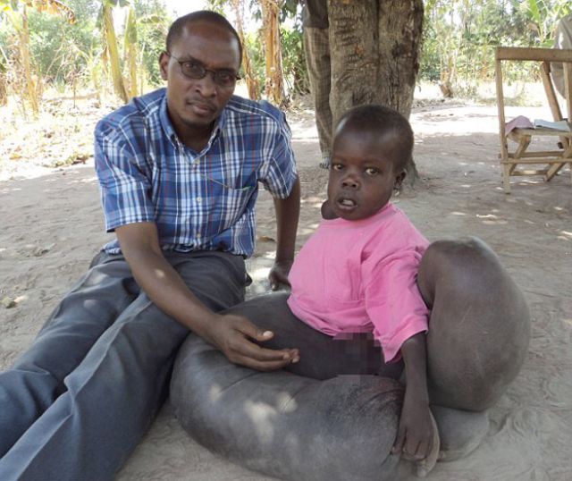 الولد الفيل.. طفل أوغندي أصيب بمرض غامض  Imgid115735