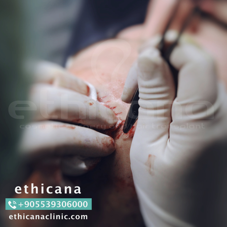 اثيكانا لزراعة الشعر في تركيا - اسطنبول | ethicana P_4231t4bp2