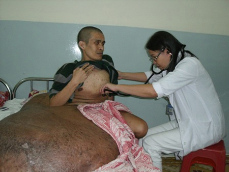 Người có khối u 90kg sẽ phẫu thuật tại Bệnh viện FV Images651082_Hai