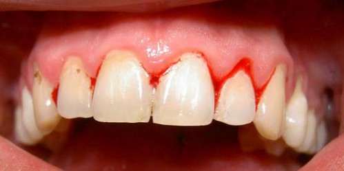 Chia sẻ: Chảy máu chân răng - nguyên nhân và cách điều trị hiệu quả Chay-mau-chan-rang-sau-khi-ngu-day