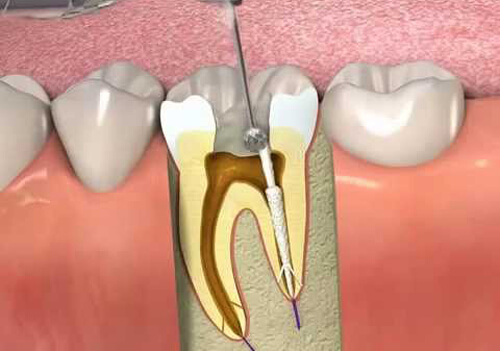Giải đáp: Hút tủy răng có đau không? Hàn trám răng hiệu quả ra sao? Lay-tuy-rang-co-anh-huong-gi-khong-5