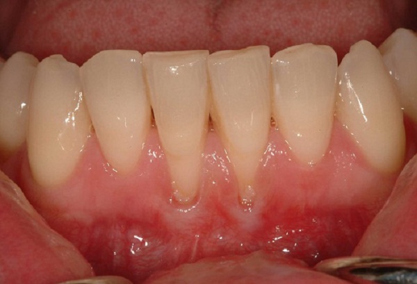 Chia sẻ: Hiện tượng bị tụt lợi chân răng và những cách điều trị hiệu quả Tut-loi-chan-rang-lam-sao-de-dieu-tri-nhanh-nhat5