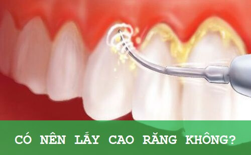 Tư vấn: Những cách lấy cao răng tại nhà hiệu quả Co-nen-lay-cao-rang1