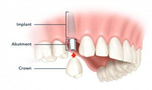 Tư vấn: Chi phí làm răng giả giá bao nhiêu là hiệu quả Photo-1-1505809539458-300x179