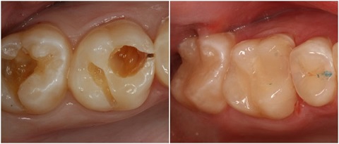 Chuyên gia chia sẻ Cách chữa sâu răng với công nghệ Laser Tech Cach-chua-sau-rang-1