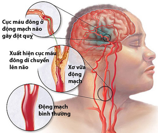 Tiểu đường là căn bệnh gây tử vong thứ 3 trên thế giới Bien-chung-khung-khiep-cua-can-benh-cuop-mang-gan-30-000-nguoi-viet-moi-nam-1