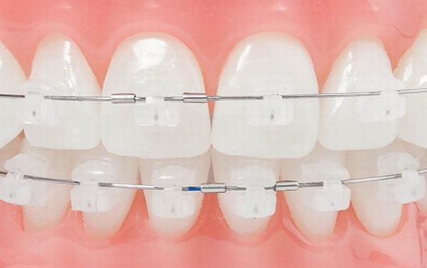 Những vấn đề cơ bản về niềng răng Nieng-rang-mac-cai-su-damon-clear-2