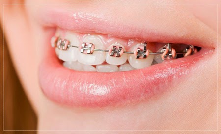 Những vấn đề cơ bản về niềng răng Nieng-rang-mot-ham
