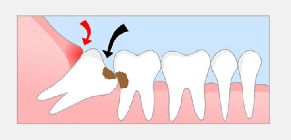 Những thông tin răng khôn là gì bạn nên biết Rang-khon-gay-hai