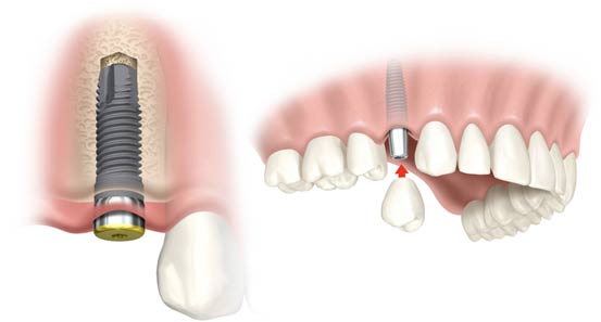  Cấy ghép răng implant giá bao nhiêu tiền? Nhung-thong-tin-ban-nen-biet-truoc-khi-lam-implant-6