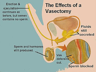 வெட்கப்படாமல் சந்தேகம் கேளுங்கள்..18+ - Page 11 Vasectomy3effects