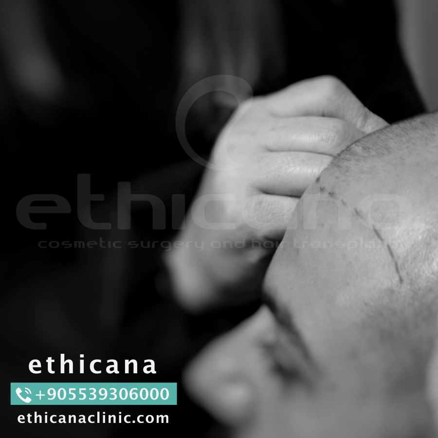 اثيكانا لزراعة الشعر في تركيا - اسطنبول | ethicana P_423iz4a63