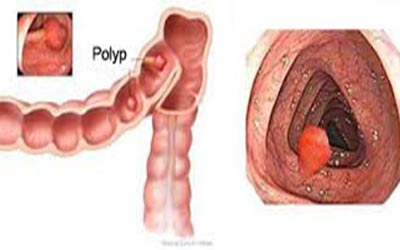 Các điểm khác nhau giữa polyp hậu môn với bệnh trĩ ngoại Bieu-hien-cua-benh-polyp-hau-mon