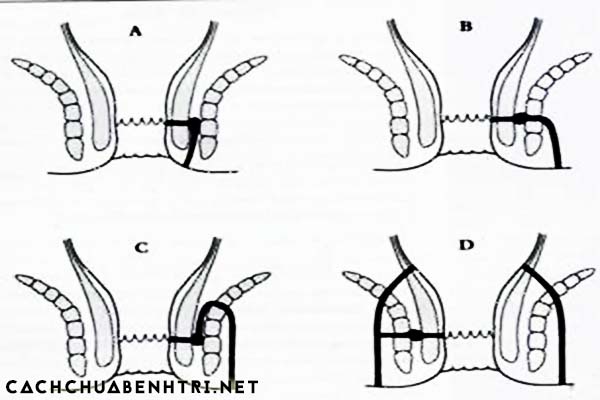 Bệnh rò trực tràng và biện pháp chữa  Nguyen-nhan-benh-do-hau-mon