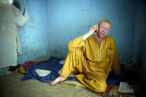 Sénégal: Les albinos seraient l'objet d'une chasse aux sacrifices Article_Albinos