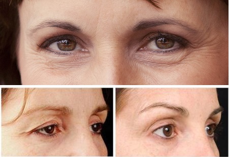 Quá trình phẫu thuật cắt da dư, mỡ thừa ở mắt Lay-lai-net-thanh-xuan-nho-cat-da-thua-mi-mat1