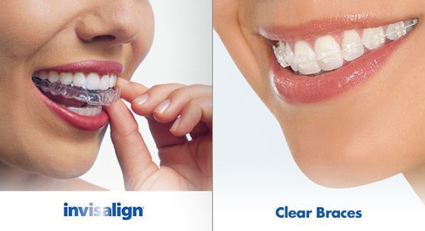 Thông tin thêm về niềng răng invisalign Thong-tin-them-ve-nieng-rang-invisalign