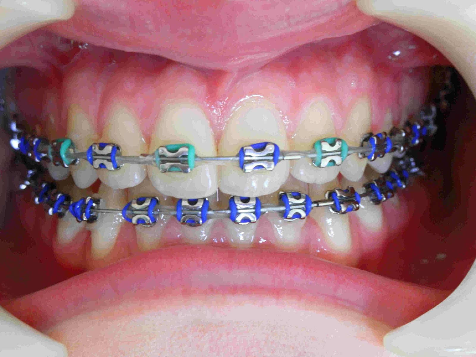 Răng bị vàng khi niềng răng không ? Rang-bi-vang-khi-nieng-rang-khong-1