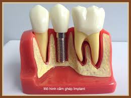 Cắm ghép răng Implant giá bao nhiêu ? Implant-gia-bao-nhieu-2