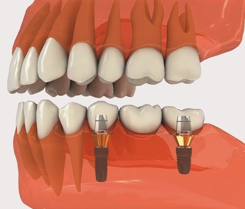 Tìm hiểu về cấy ghép Implant Tai-sao-tru-implant-co-chi-phi-cao-01