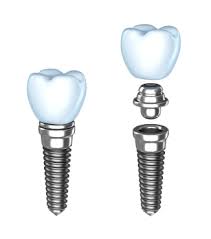 3 điều cần biết về phương pháp cấy ghép implant 3-dieu-can-biet-ve-phuong-phap-cay-ghep-implant-1