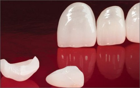 Giá trồng răng Implant Boc-rang-toan-su-gia-bao-nhieu-tien-thi-hop-ly-450x284