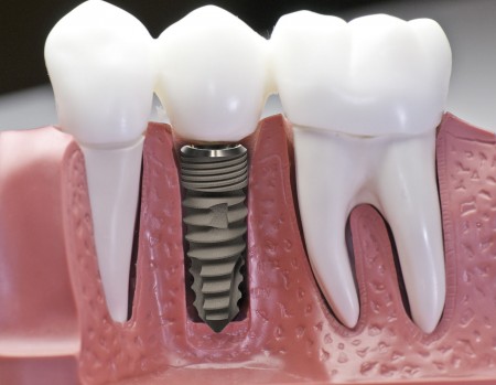 Cấy ghép implant có an toàn không? Cay-ghep-implant-450x349