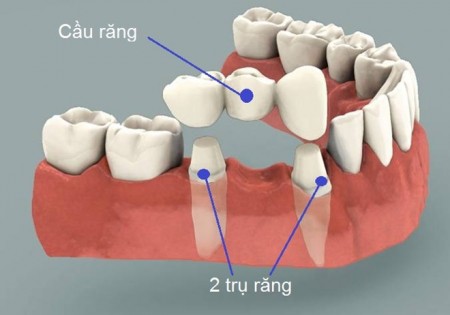 Cấy ghép implant ở đâu ? Nha-khoa-can-tho-3-450x315