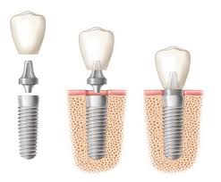 Trồng răng với phương pháp cấy ghép implant Trong-rang-voi-phuong-phap-cay-ghep-implant