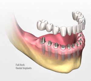 Trồng răng hiệu quả với phương pháp implant Phuong-phap-trong-rang-implant-300x267